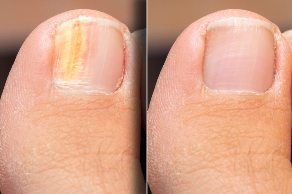 Unhealthy nail compared to a Healthy Nail