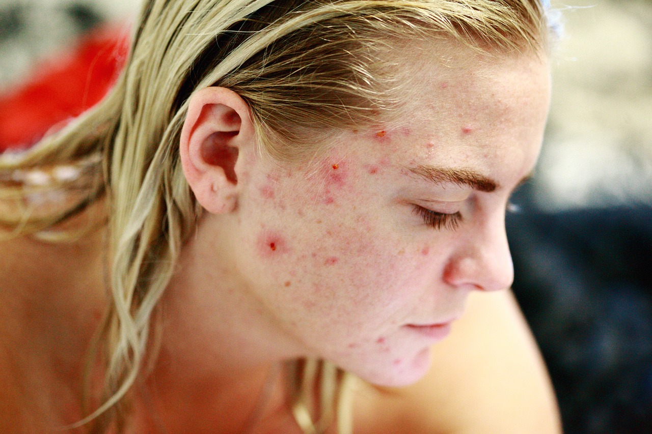 Adult Acne, Acne, sensitivity